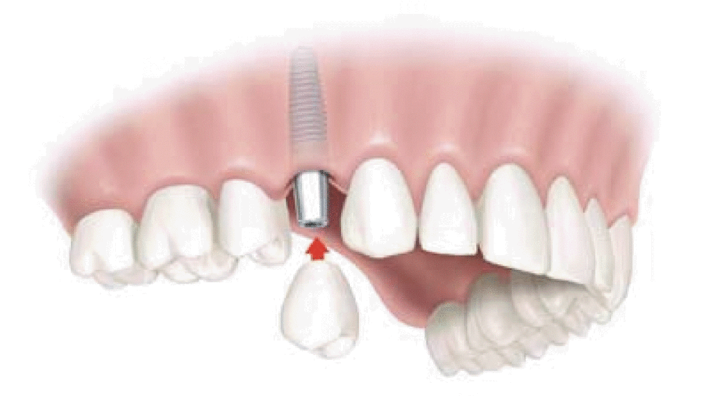 Dental Implants Restore Function to Teeth Dental Implants VA