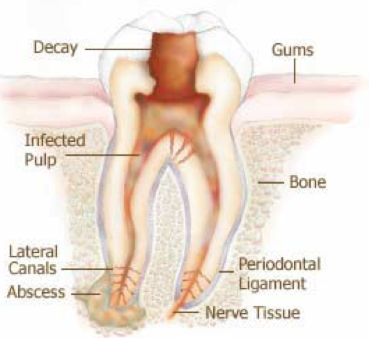 The Root Canal - Grove Avenue Dentistry in Richmond, VA